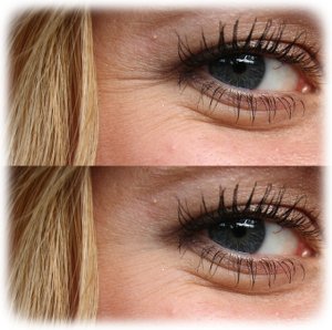 microneedling wrinkles6